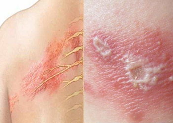 Các bệnh da liễu được miễn nghĩa vụ quân sự